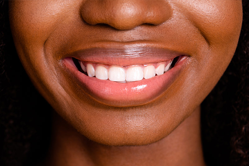 Zoom Teeth Whitening in Live Oak